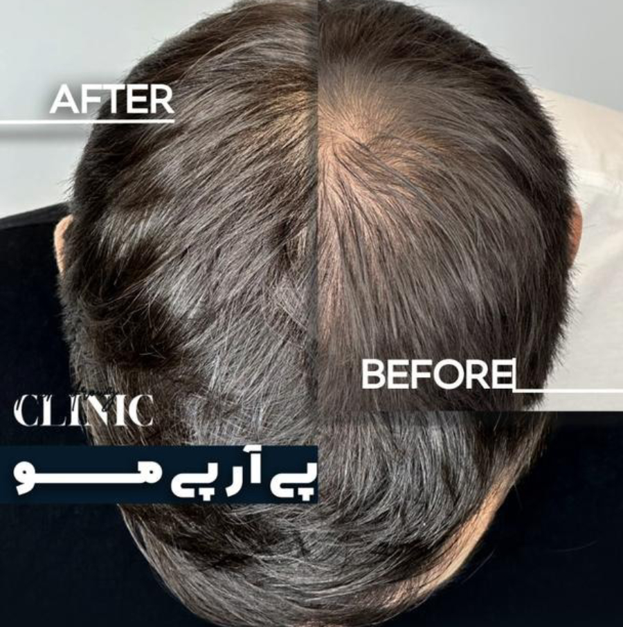 انواع پی آر پی - تصویر 2