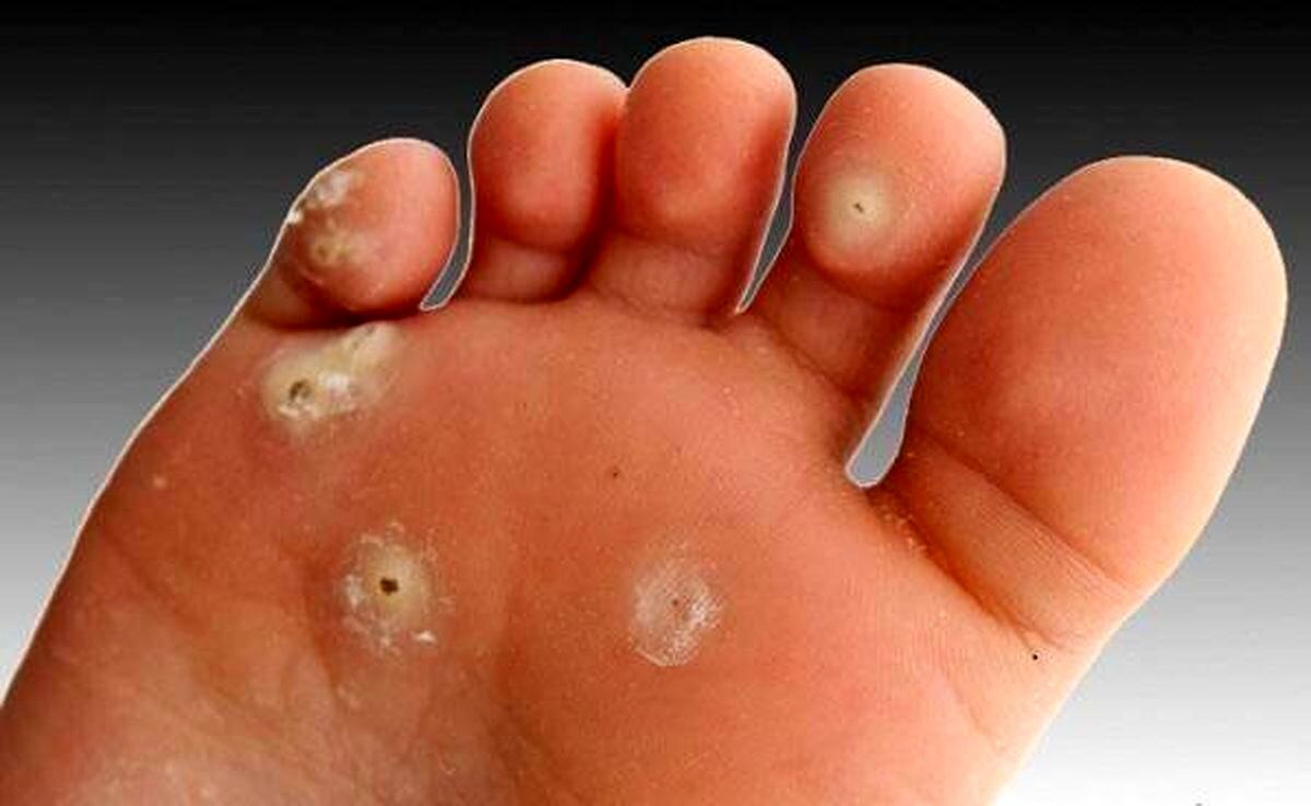 میخچه چگونه درمان می‌شود؟