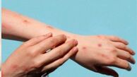 آبله میمونی مشابه کووید نیست