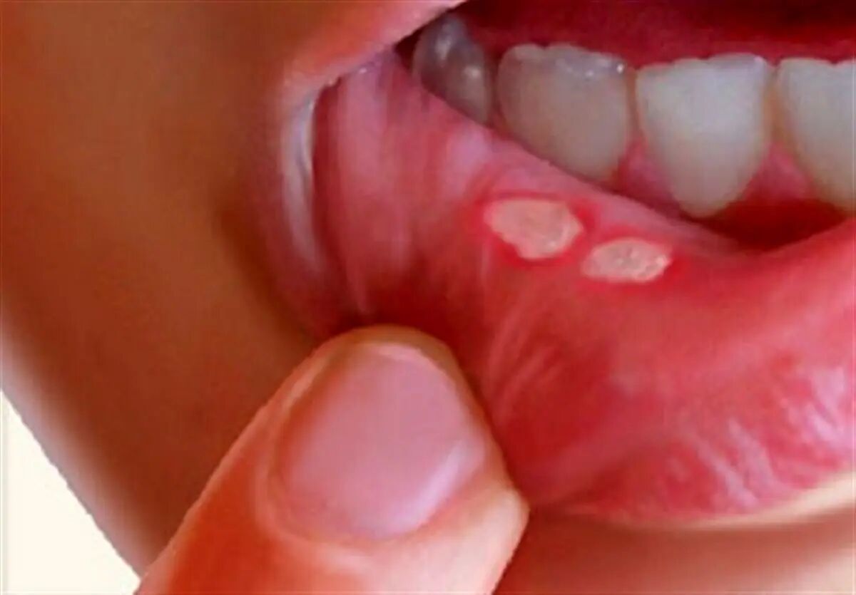 چگونه "آفْت دهان" خود را با چند راهکار طب سنتی درمان کنیم؟