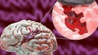 این گروه خونی بیشترین احتمال سکته مغزی را دارد!