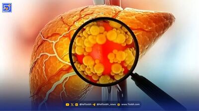 کبد چرب چیست؟ علائم، دلایل و راه‌های پیشگیری که باید بدانید