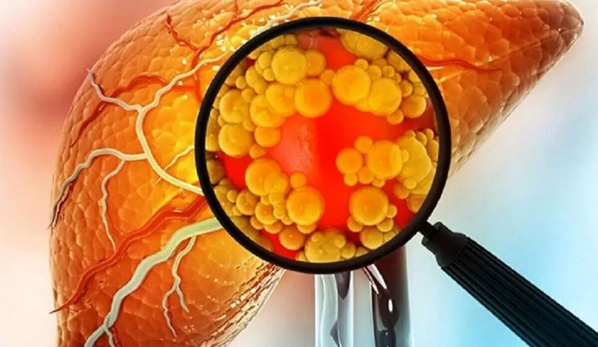 تشخیص کبد چرب از روی چهره