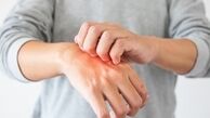 بهترین دارو خانگی برای خارش بدن